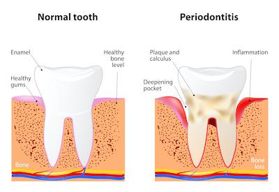 gum disease stages illustration in rutland