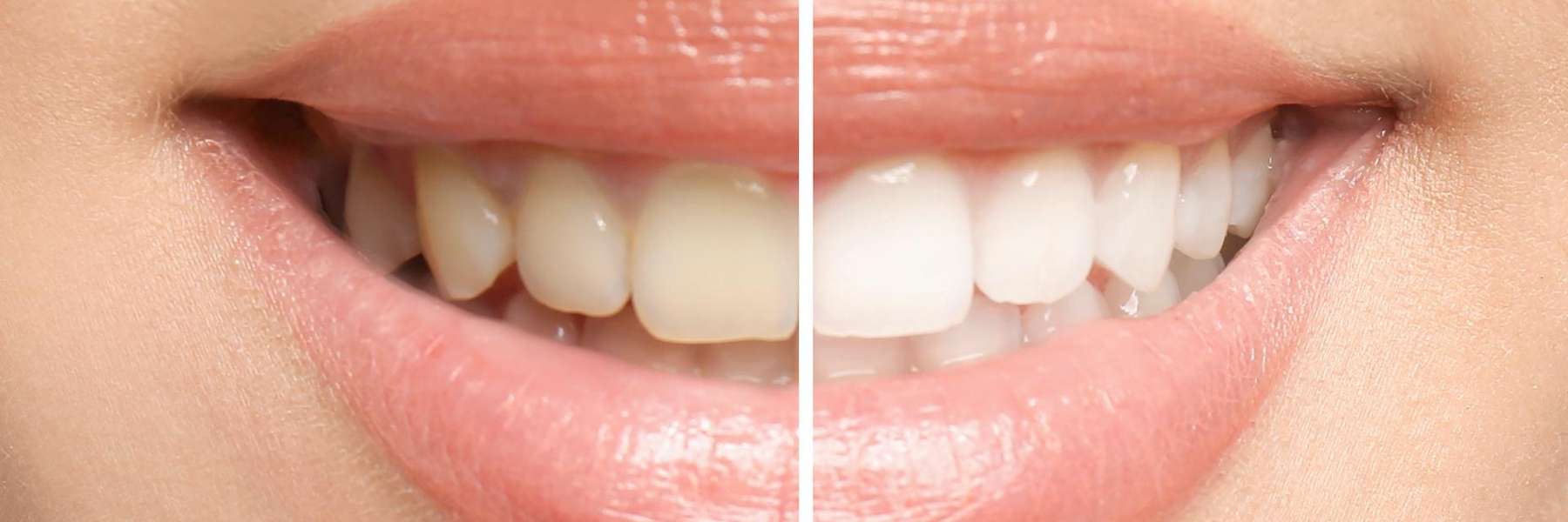 Teeth whitening effect in Rutland MA | Laser dentistry
