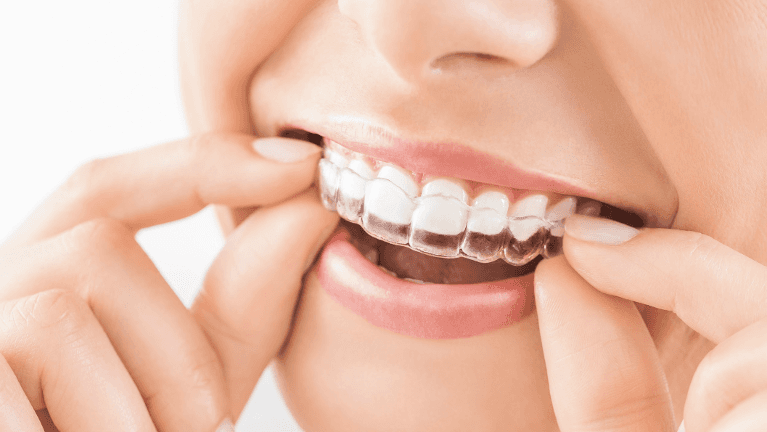 A young woman putting on her transparent Invisalign in Rutland