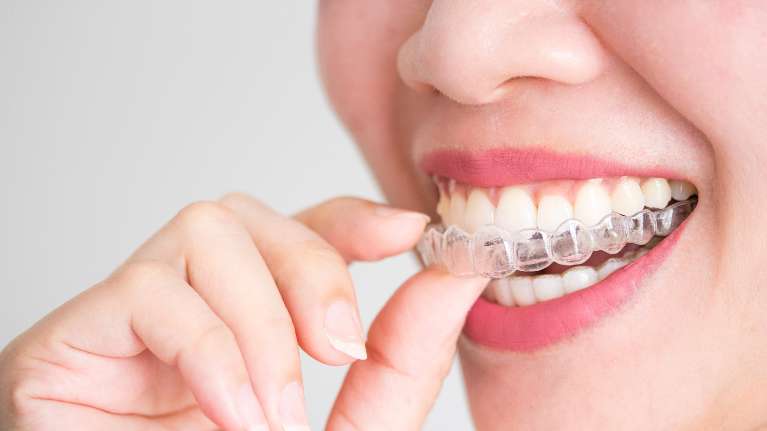 a woman wearing Invisalign in Rutland, MA.