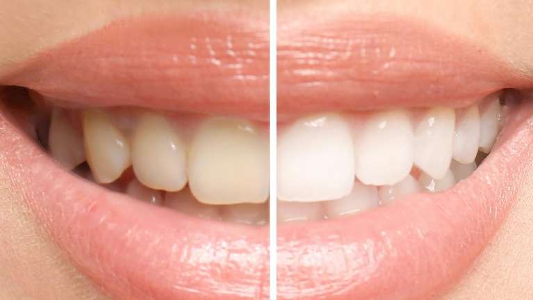 Before and after photo showcasing teeth whitening results in Rutland, MA.