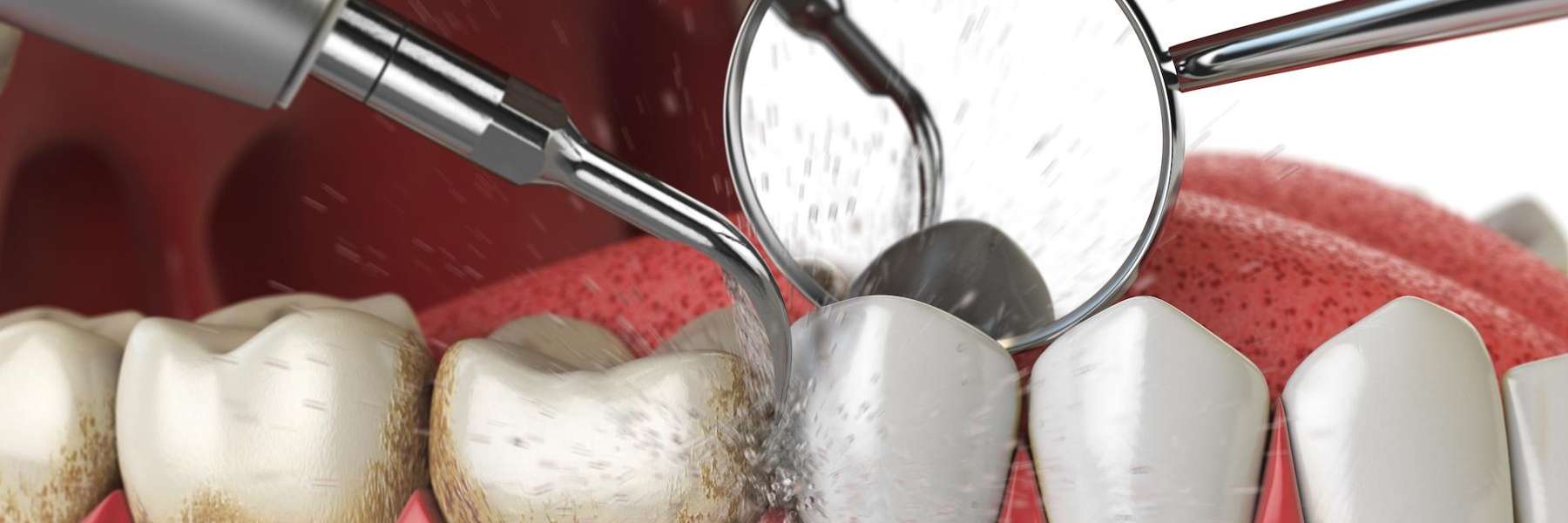 Dental cleaning of molar tartar in Rutland MA