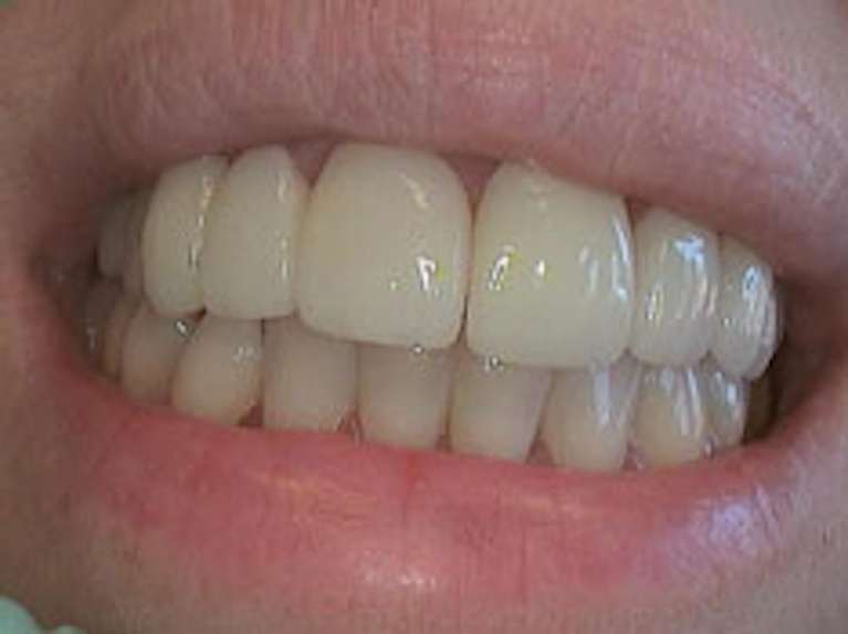 veneers after | dentist paxton