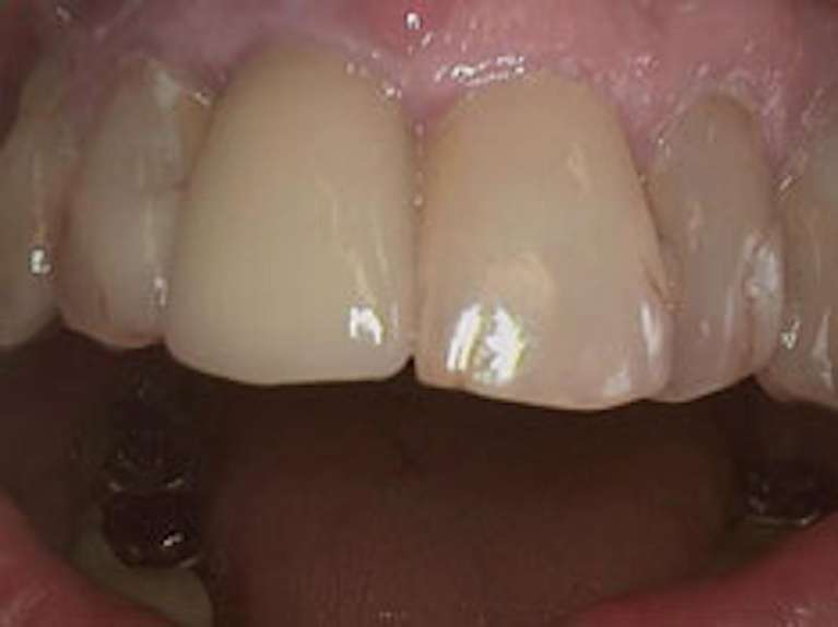 dental crown after | dentist paxton