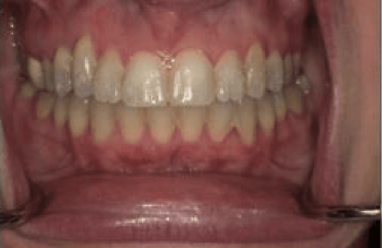 after Invisalign treatment | dentist princeton