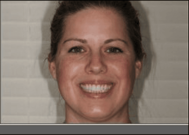 Invisalign after photo | dentist princeton