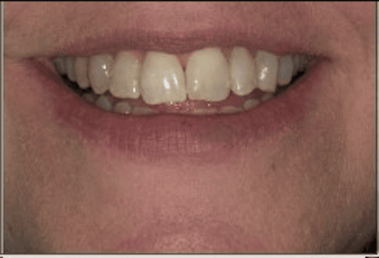 Invisalign after photo | dentist princeton