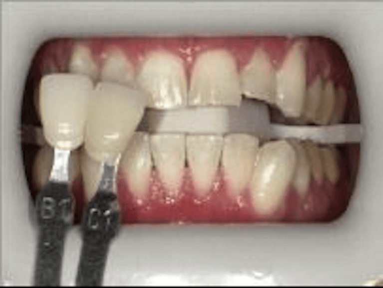 teeth whitening after | dentist princeton