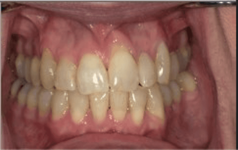 after invisalign treatment | dentist princeton