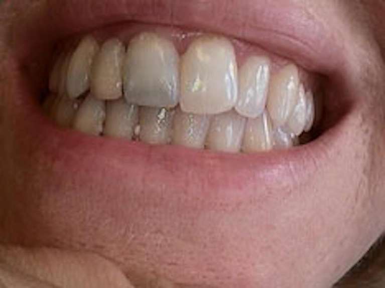 veneers before | dentist paxton
