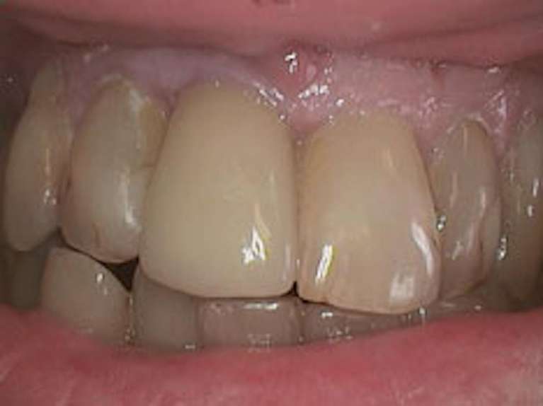 Dental crown before | dentist paxton