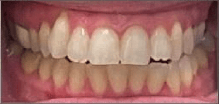 before Invisalign treatment | dentist princeton