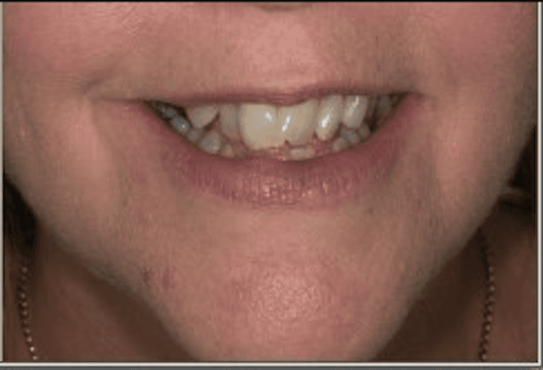 Invisalign before photo | dentist princeton