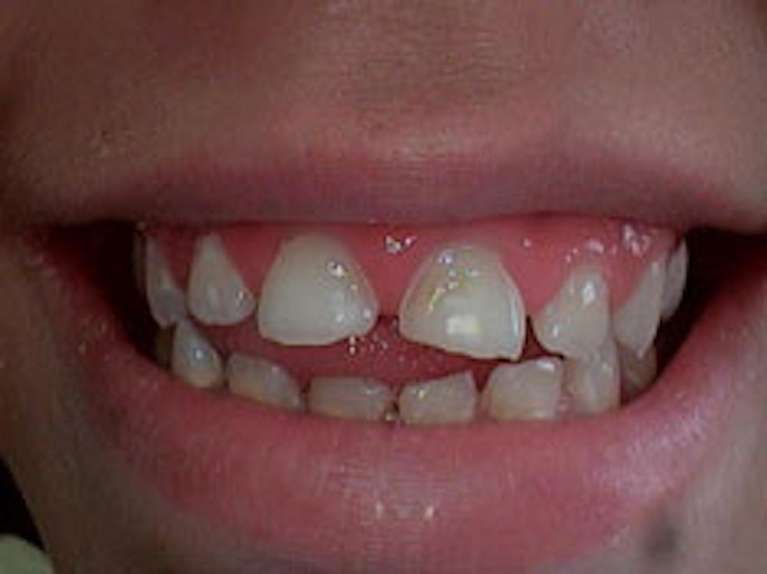 cosmetic dentistry before | dentist paxton