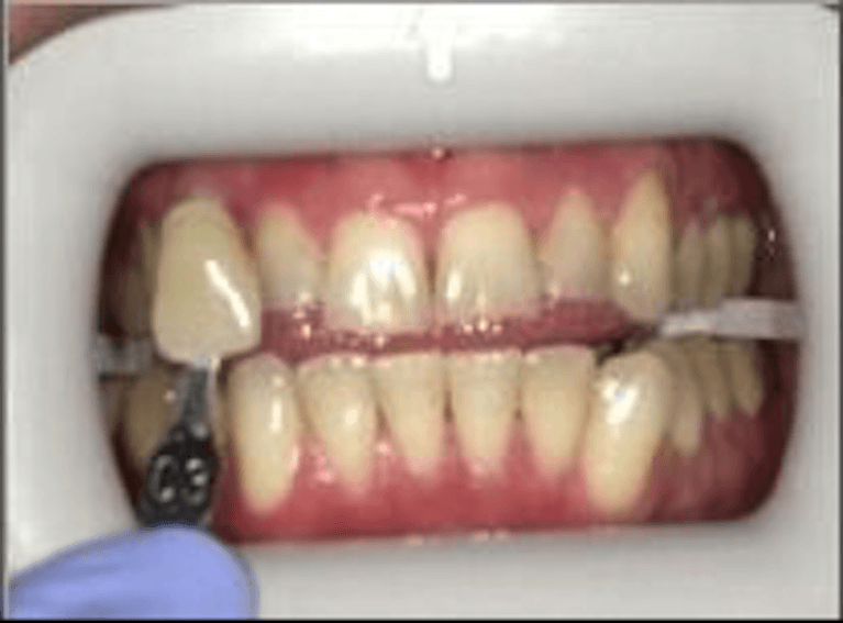 teeth whitening before | dentist princeton