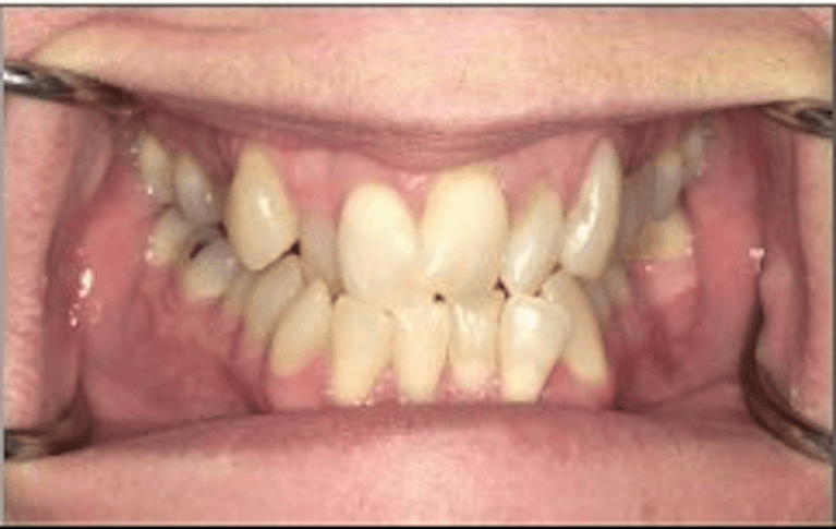 before invisalign treatment | dentist princeton